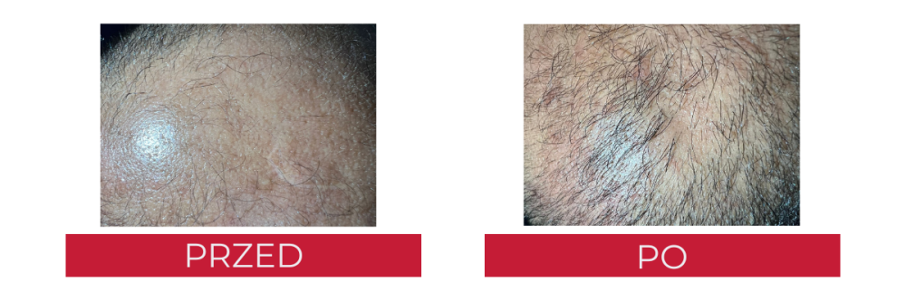 Efekty kuracji Seboradin MEN przeciw wypadaniu włosów