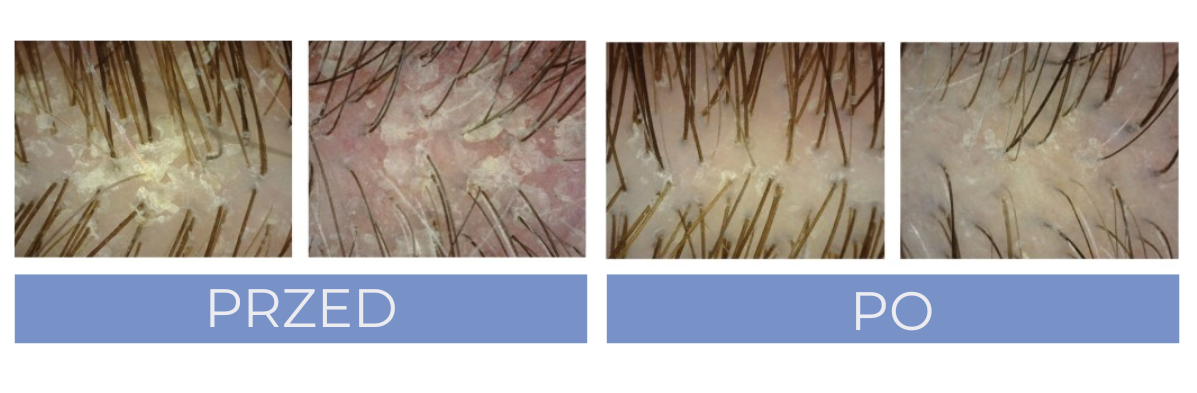 Seboradin ANTI-DANDRUFF. Skuteczność kuracji przeciwłupieżowej Seboradin